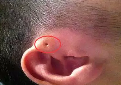 宝宝耳朵上有孔是怎么回事 孩子耳朵上有孔怎么办