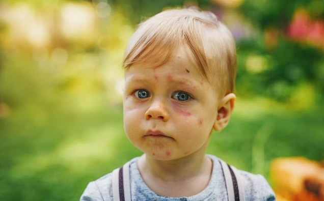 宝宝夏季容易出现的皮肤问题 夏季如何做好婴儿皮肤护理
