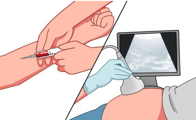 皮下埋值避孕手术什么时候做合适 皮埋避孕法的副作用
