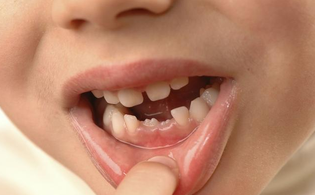 孩子几岁会换牙 孩子换牙需要拔牙吗