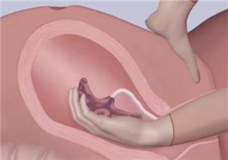 手剥胎盘痛不痛 胎盘留在体内对产妇的危害