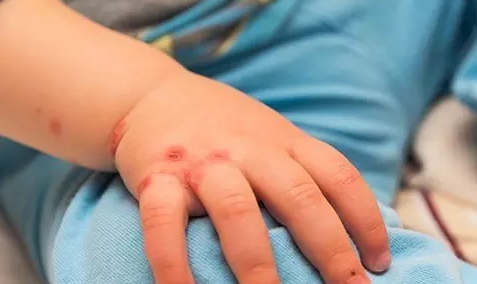 孩子的湿疹为什么会越来越多 婴儿湿疹护理有哪些误区