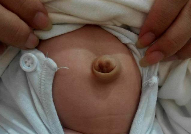 肚脐鼓包|宝宝肚脐鼓包是怎么回事 宝宝脐疝护理方法