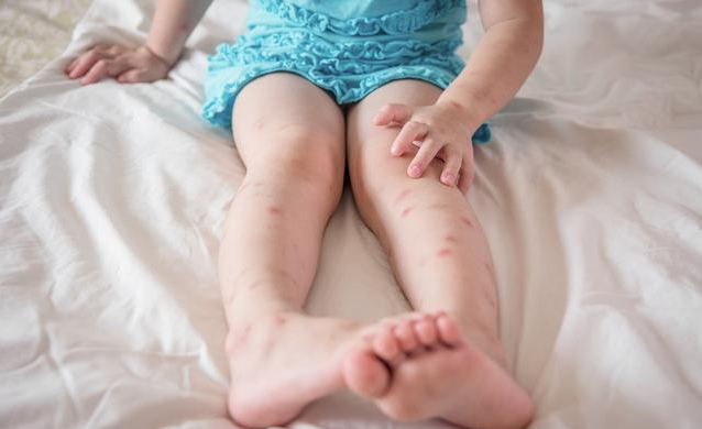 宝宝被蚊子咬了怎么止痒比较好 这些错误止痒方法要避免