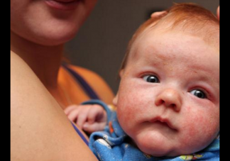 宝宝得了湿疹还能给宝宝喂奶吗 宝宝得了湿疹怎么护理