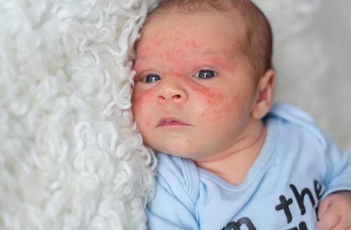 婴儿玫瑰疹是什么 婴儿出现玫瑰疹怎么办