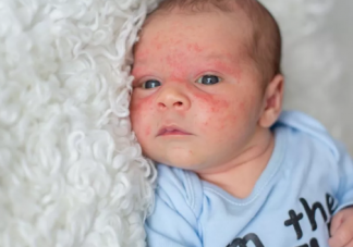 婴儿玫瑰疹是什么 婴儿出现玫瑰疹怎么办