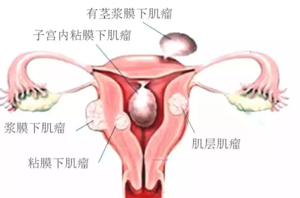 带着肌瘤怀孕会发生什么 预防子宫肌瘤吃什么好