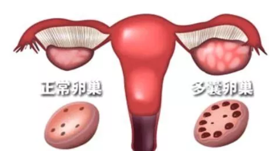 卵巢多囊样改变和多囊综合征区别 卵巢多囊样改变是什么