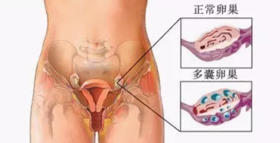 卵巢多囊样改变怎么治疗 卵巢多囊样改变会影响怀孕吗