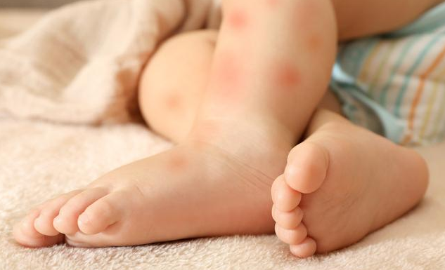 哪些食物容易引起宝宝过敏 怎么预防宝宝辅食过敏