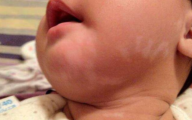 皮肤白斑|宝宝脸上长白斑是肚子里虫子吗 脸上白斑是白色糠疹吗