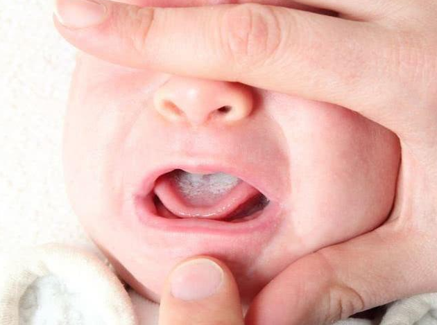 宝宝长鹅口疮有哪些危害 宝宝长鹅口疮的护理方法