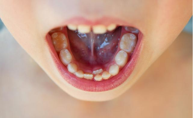 双排牙|孩子长双排牙要拔吗 孩子双排牙有什么危害