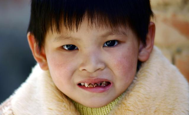 孩子不吃糖也会长蛀牙吗  预防孩子长蛀牙的措施