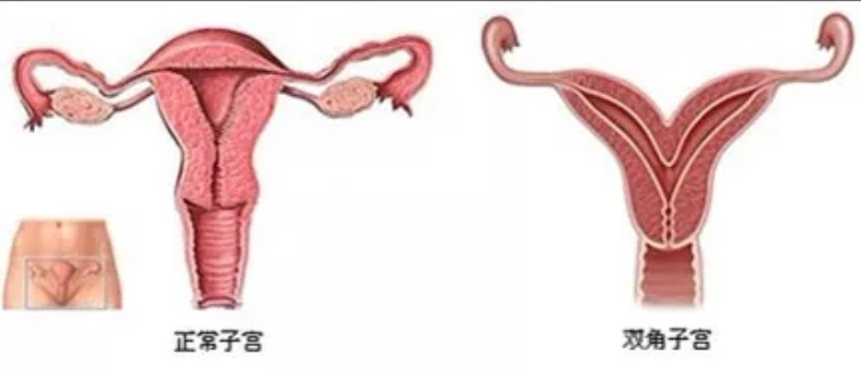 子宫畸形是怎么造成的 子宫畸形种类有哪些