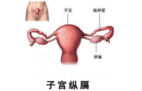 得了纵膈子宫能怀孕吗 子宫纵隔的症状有哪些
