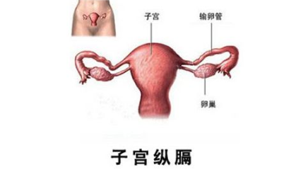子宫纵隔是子宫畸形吗 纵膈子宫怀孕注意事项