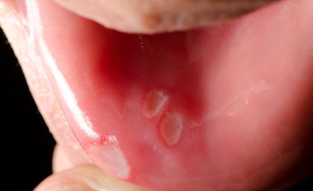 口腔溃疡一直不好会得口腔癌吗 什么症状的口腔溃疡要引起重视