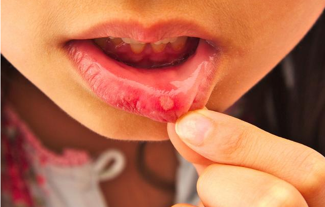 口腔溃疡一直不好会得口腔癌吗 什么症状的口腔溃疡要引起重视
