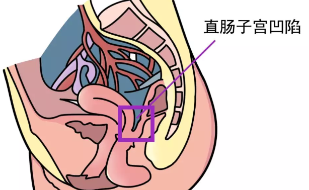 病理性盆腔积液会痛经吗 为什么盆腔积液会影响女性怀孕