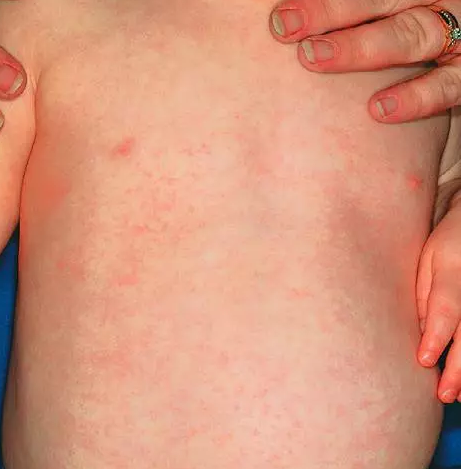 宝宝热疹和湿疹有什么区别 宝宝湿疹该怎么护理