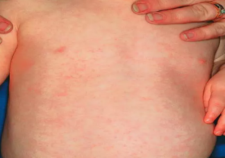 宝宝热疹和湿疹有什么区别 宝宝湿疹该怎么护理