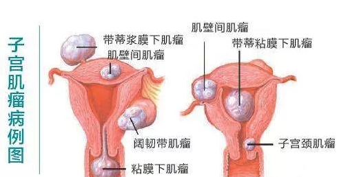 子宫内膜息肉是怎么形成的 子宫内膜息肉的危害有哪些