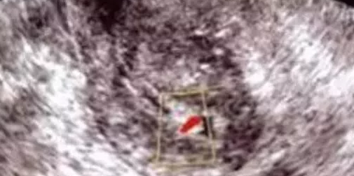 子宫内膜息肉的治疗方法 子宫内膜息肉影响怀孕吗