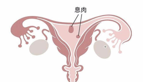子宫内膜息肉患能吃黄体酮治疗吗 子宫息肉可以自然消退吗