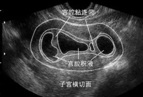 宫腔粘连会导致不孕吗 宫腔粘连主要临床表现