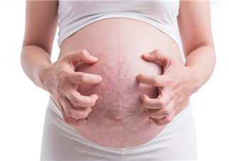 怀孕长妊娠纹为什么会痒 孕期长妊娠纹痒怎么办