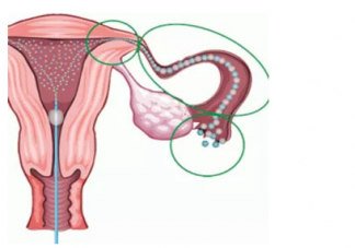 输卵管堵塞还可以排卵吗 输卵管堵塞有什么症状