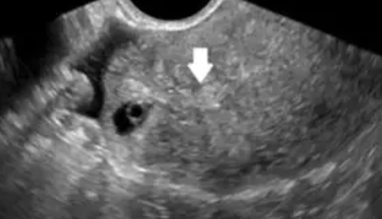 输卵管间质部妊娠特点 输卵管间质部妊娠是什么