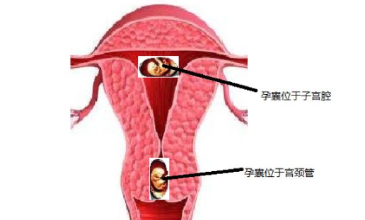 宫颈妊娠诊断标准 宫颈妊娠有哪些症状影响