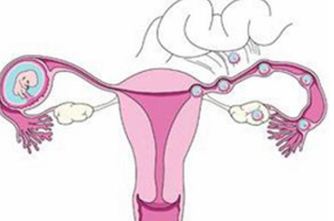 宫颈妊娠的发生原因 宫颈妊娠和流产过有关吗