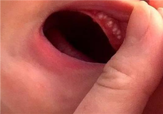 孩子嘴里的马牙能挑破吗 如何区分马牙和鹅口疮
