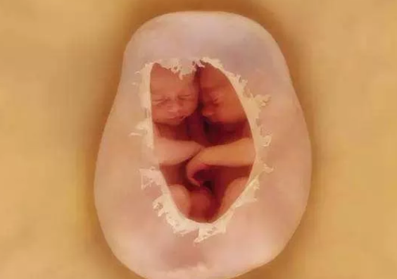 单角子宫如何怀孕 单角子宫危害影响有哪些