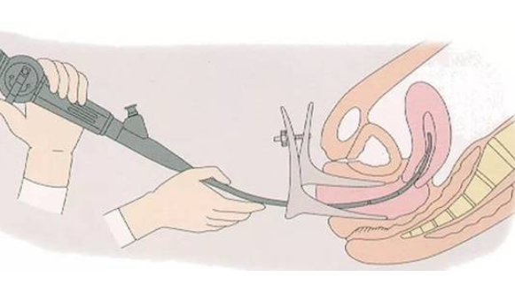 宫腔镜检查需要住院吗 哪些情况需要做宫腔镜检查