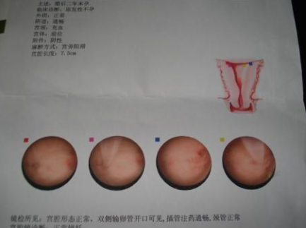 宫腔镜检查后多久可以同房 宫腔镜检查后多久可以有性生活