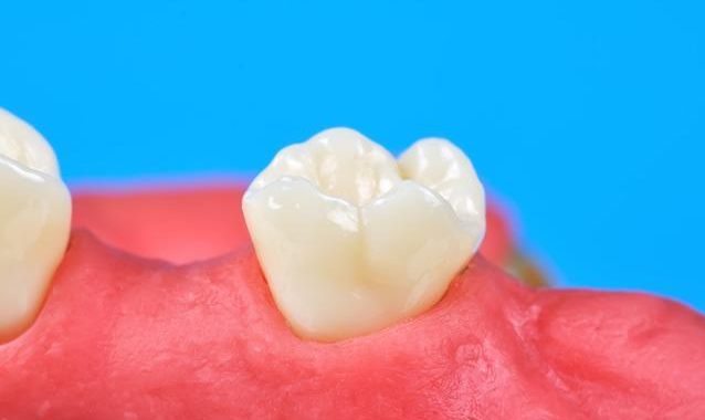 长智齿牙龈肿痛怎么办 哪些情况是必须要拔除智齿