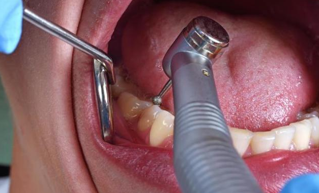 长智齿牙龈肿痛怎么办 哪些情况是必须要拔除智齿