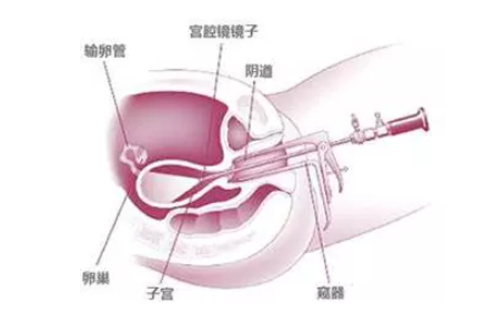 电刀手术对内膜损伤大真的吗 宫腔镜电刀手术安全吗
