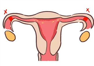 子宫输卵管造影前要做哪些检查 做了造影就可以疏通输卵管吗