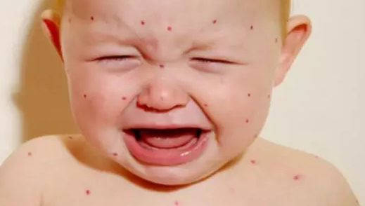 宝宝猩红热后期症状有哪些 宝宝猩红热发生的原因