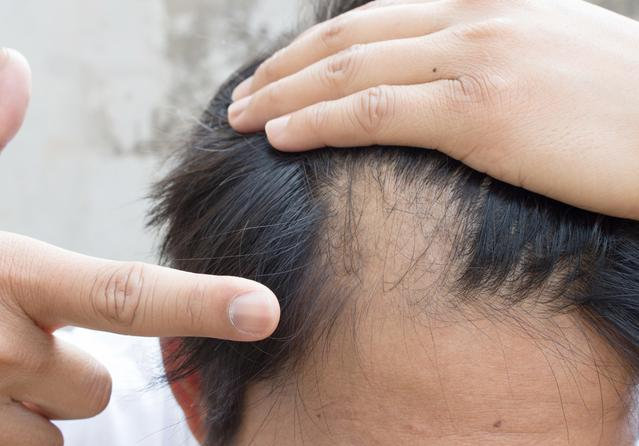 脱发会有遗传吗 脱发的原因都有哪些