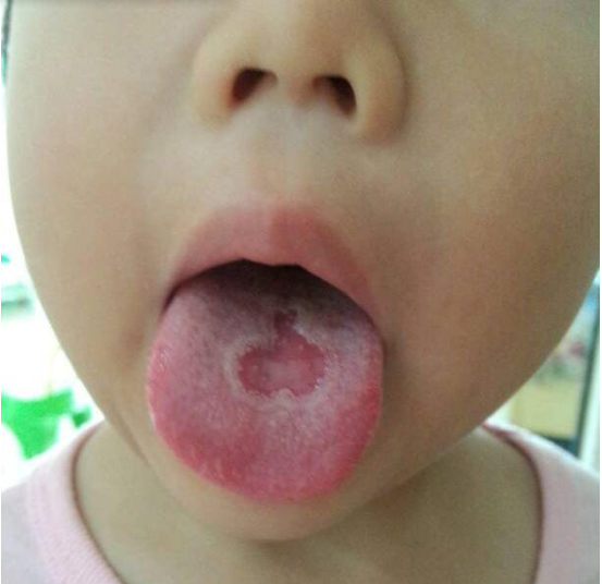 宝宝地图舌是身体有问题吗 孩子地图舌常见症状有哪些