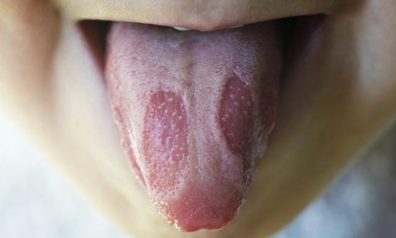 宝宝地图舌是身体有问题吗 孩子地图舌常见症状有哪些