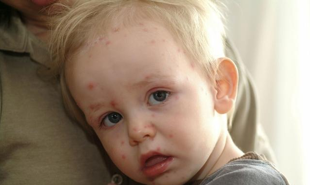 宝宝出水痘怎么快速止痒 出水痘应该要注意什么