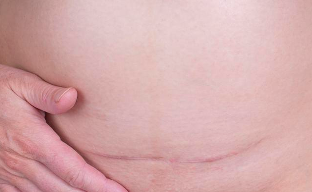 剖宫产二胎会导致子宫破裂吗 哪些孕妇适合剖腹产后阴道生产
